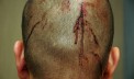 Trayvon Martin: Pics Show Zimmerman Injuries